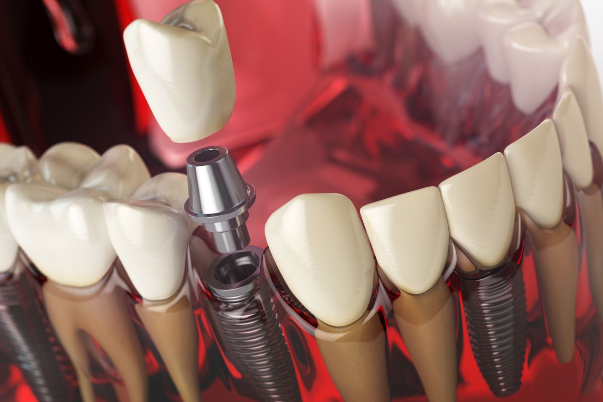 recovery after dental implants