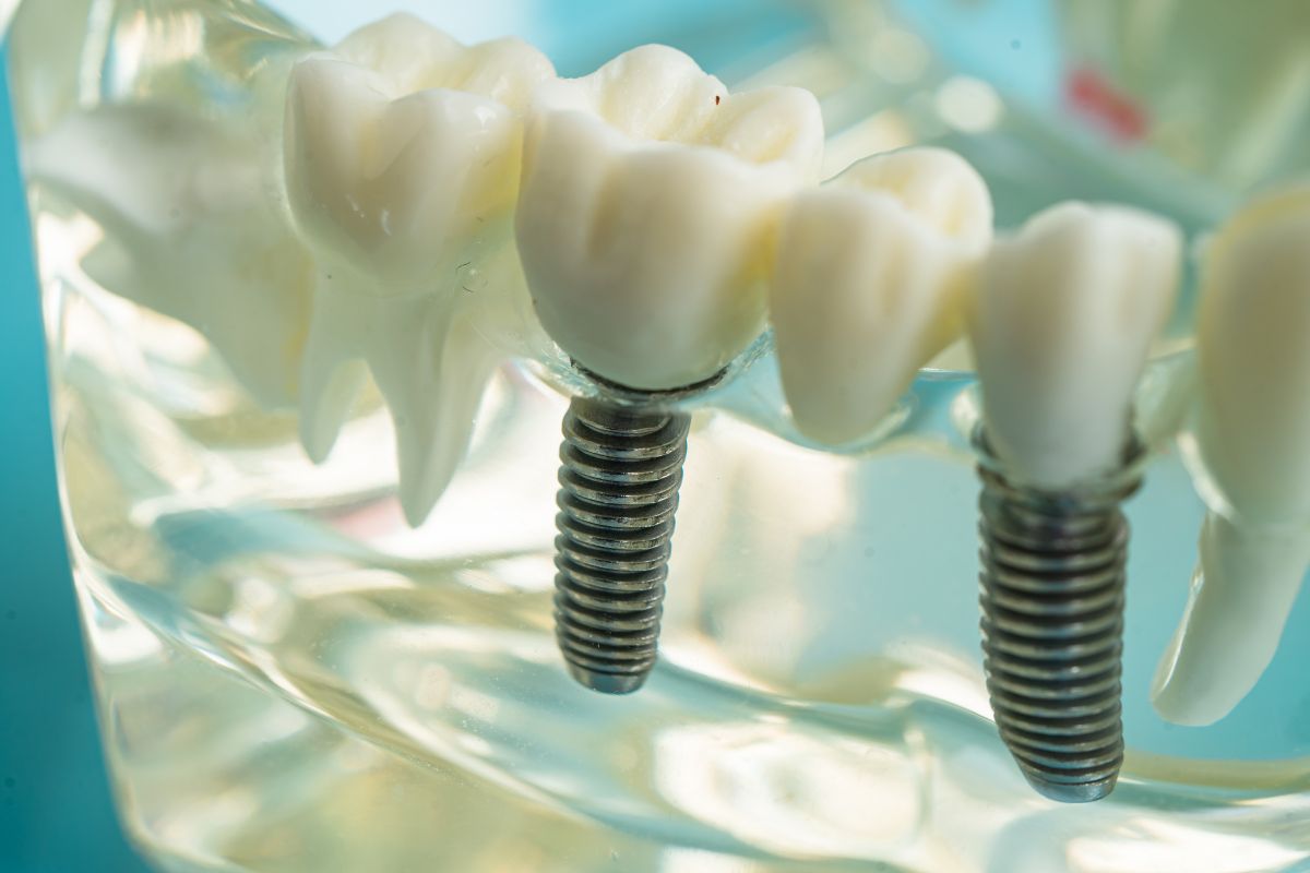 what are dental implants